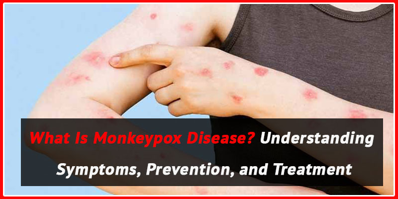 Monkeypox Understanding Symptoms and Prevention